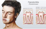 Parodontitis - wenn das Zahnfleisch zurückgeht
